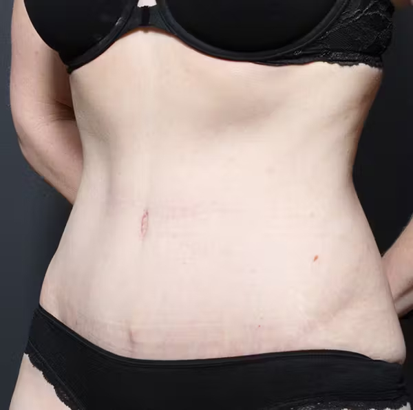Tummy tuck