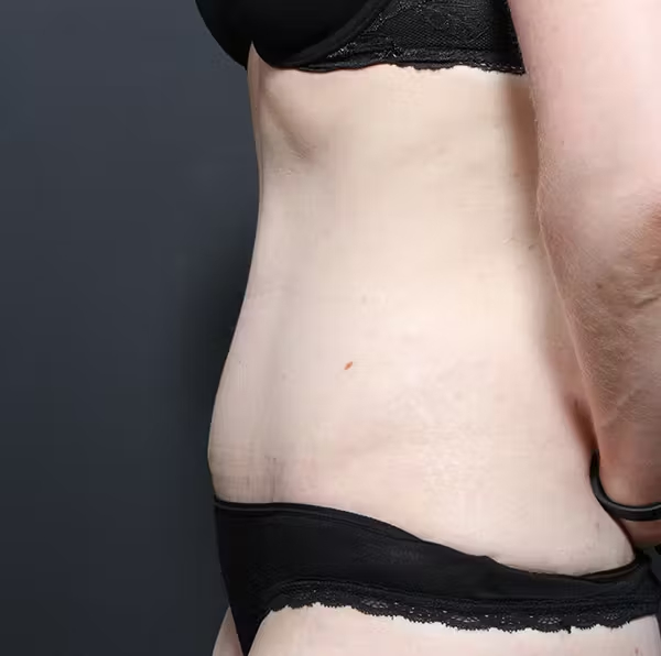 Tummy tuck