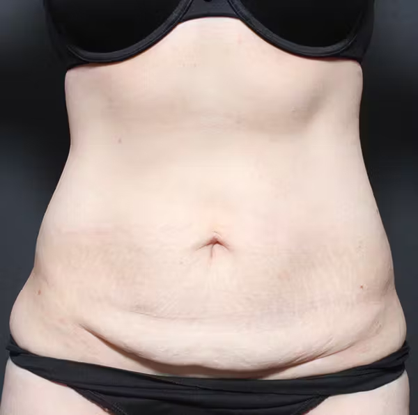 Tummy tuck