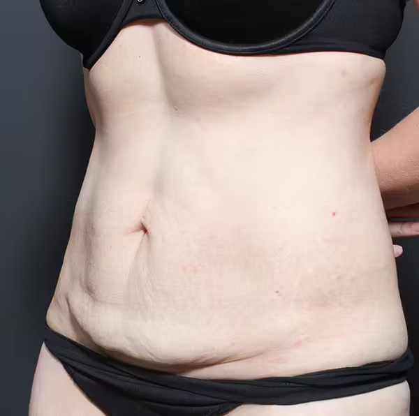 Tummy tuck