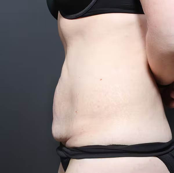 Tummy tuck