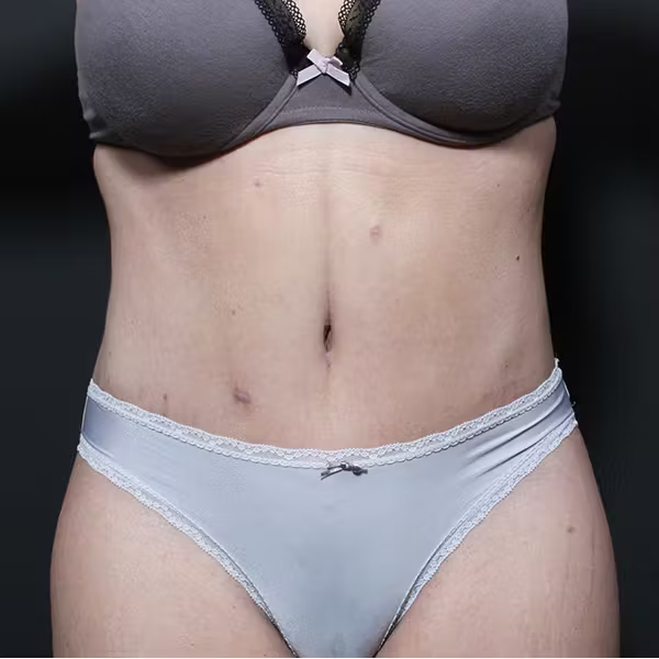 Tummy tuck