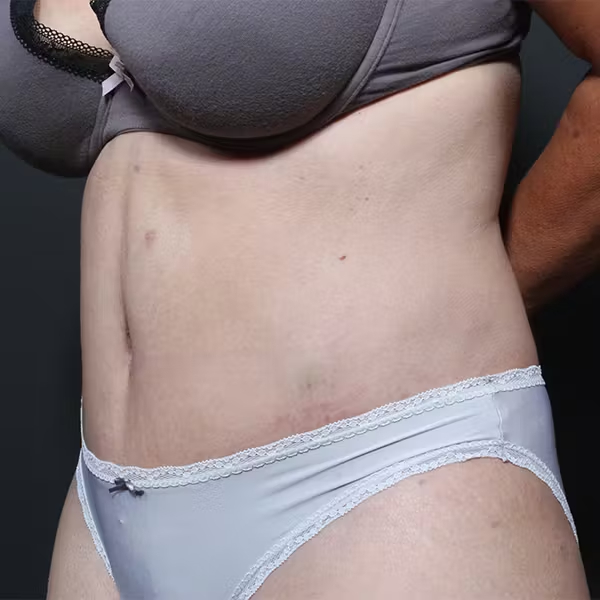 Tummy tuck
