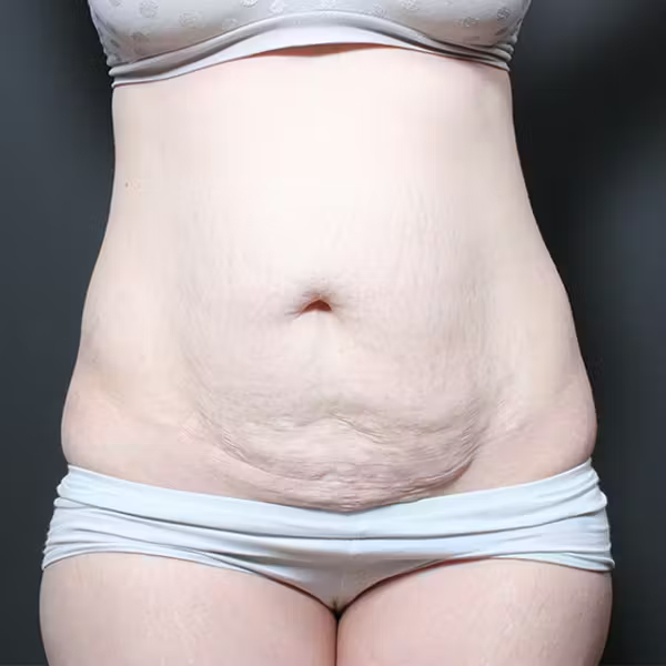 Tummy tuck