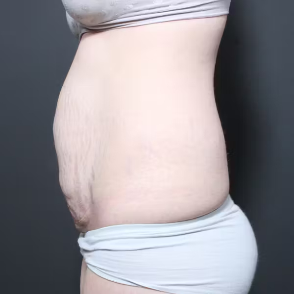 Tummy tuck