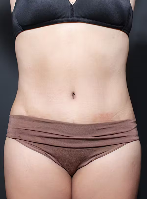 After Image: Tummy tuck - front