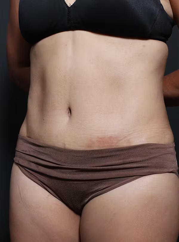 After Image: Tummy tuck - left-front-oblique