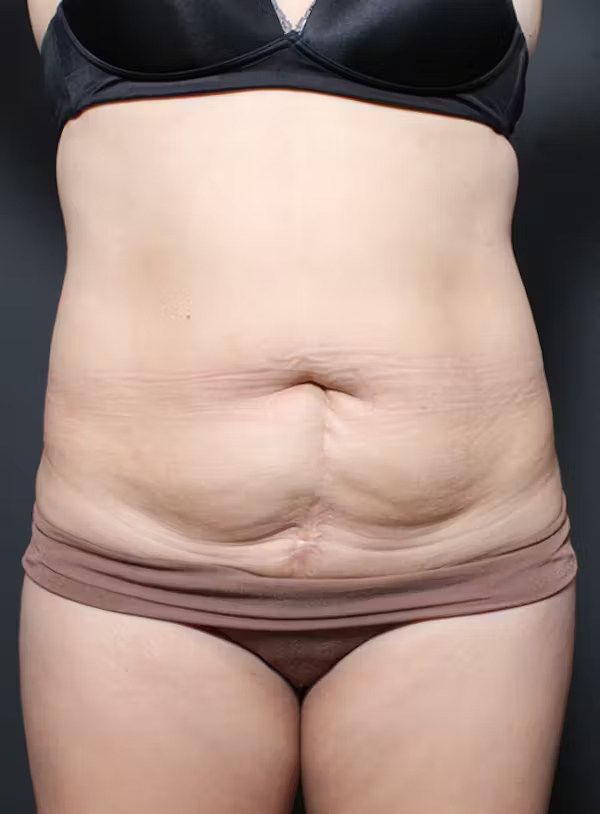 Before Image: Tummy tuck - front