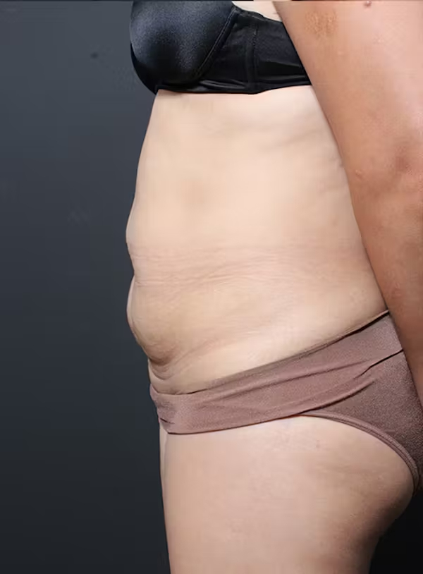 Before Image: Tummy tuck - left-side