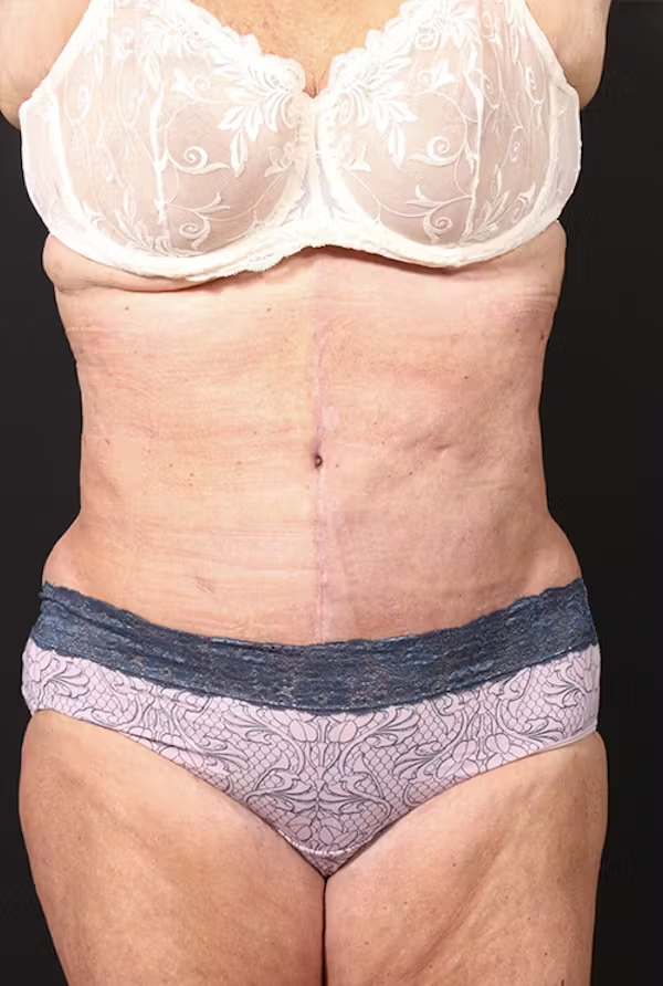 Tummy tuck