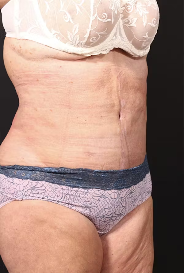 Tummy tuck