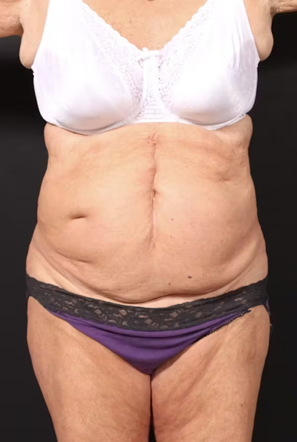 Tummy tuck