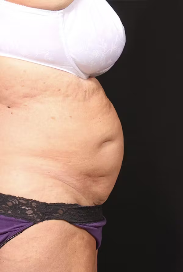 Tummy tuck