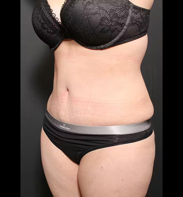 Tummy tuck
