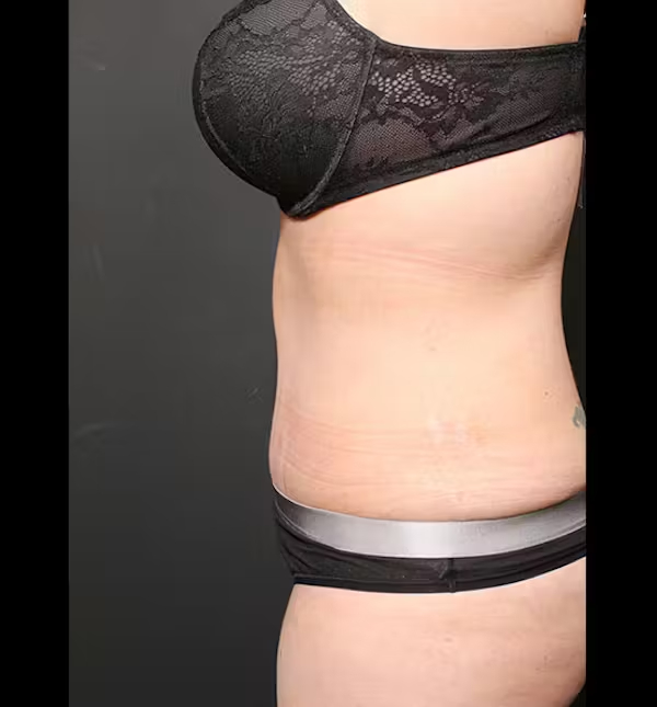 Tummy tuck