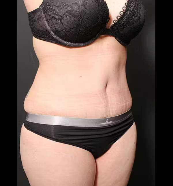 Tummy tuck