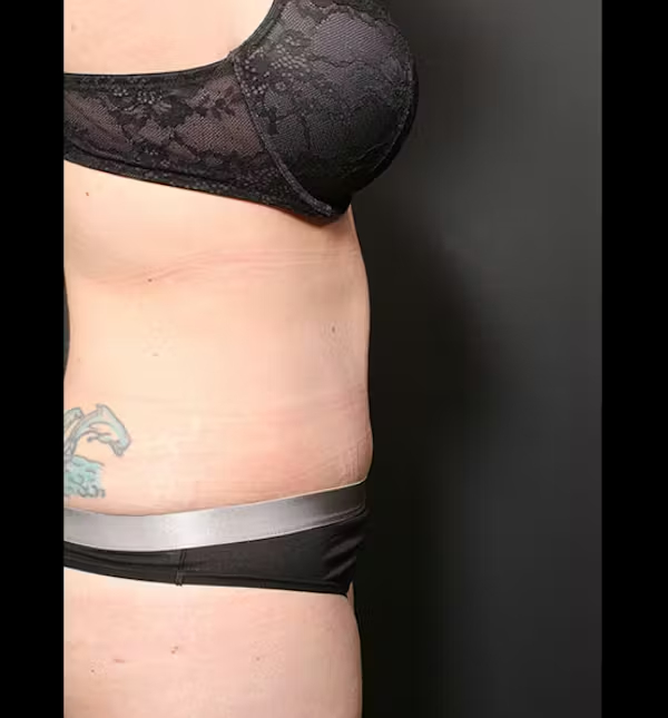 Tummy tuck