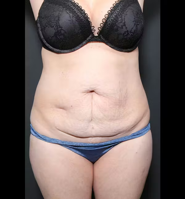 Tummy tuck