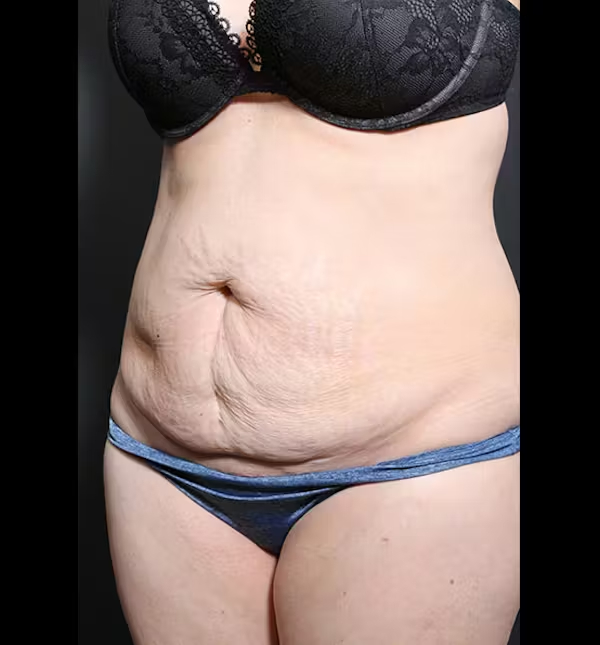 Tummy tuck