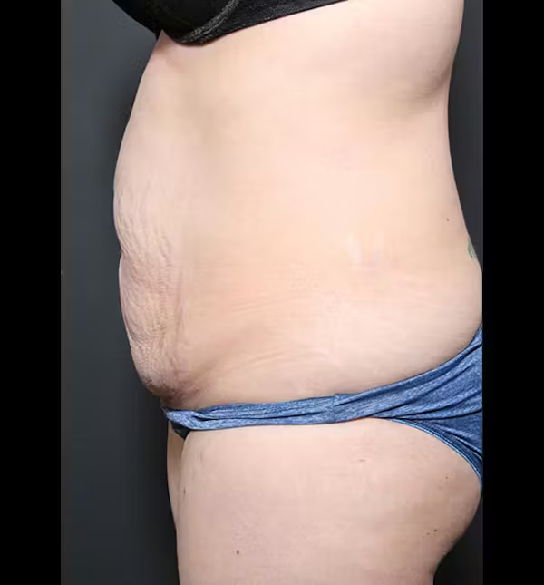 Tummy tuck