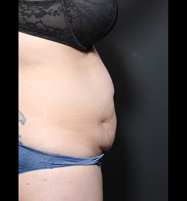 Tummy tuck