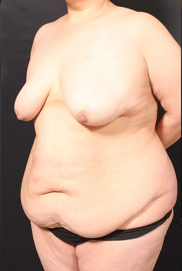 Before Image: Tummy tuck - left-front-oblique