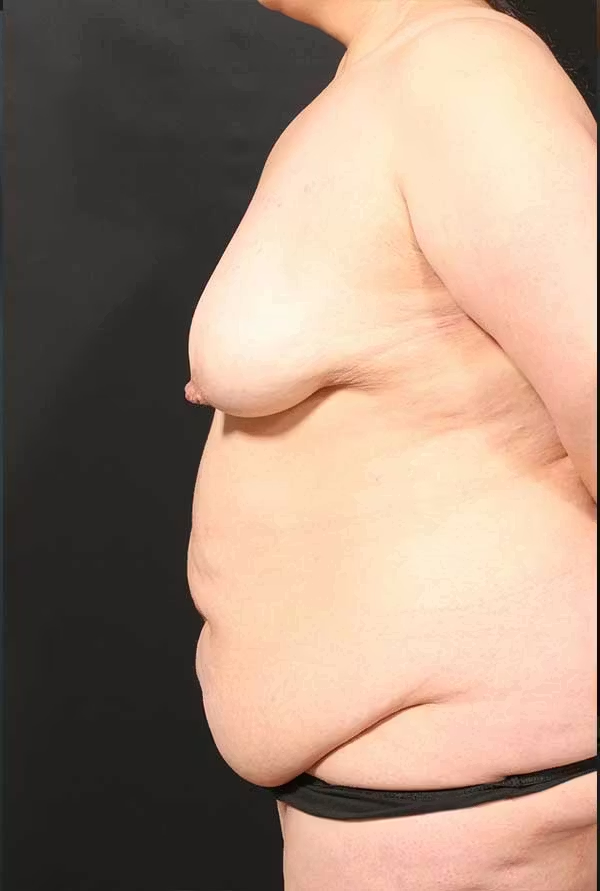 Before Image: Tummy tuck - left-side