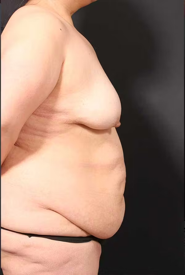 Before Image: Tummy tuck - right-side