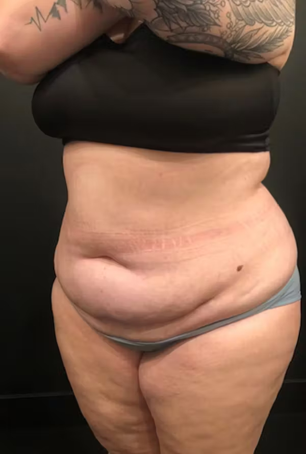 Tummy tuck