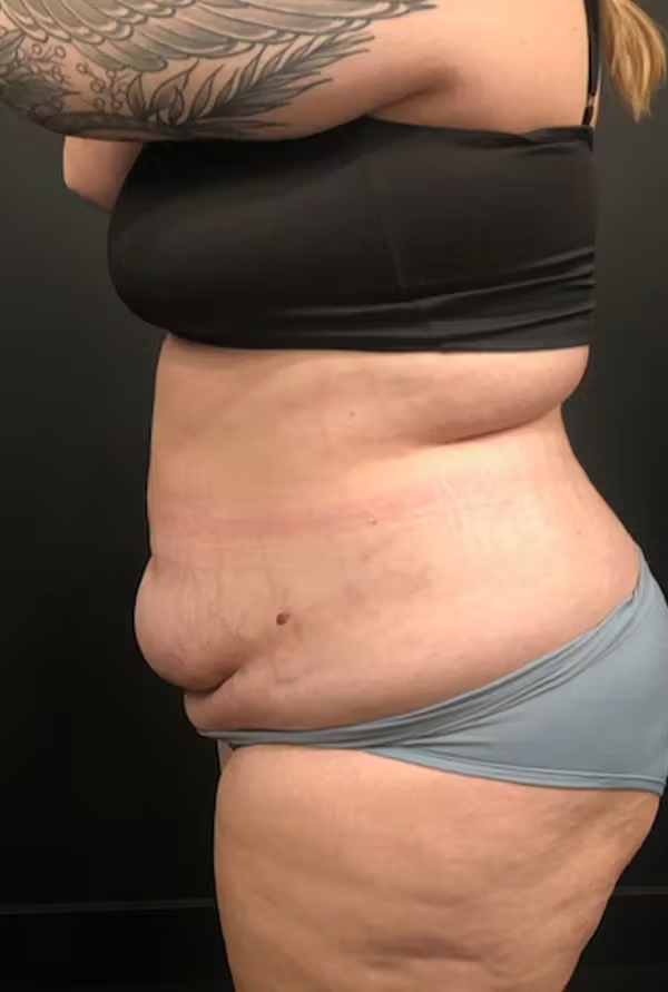 Tummy tuck