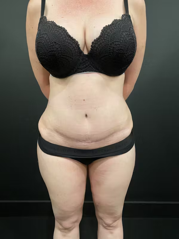 After Image: Tummy Tuck - front