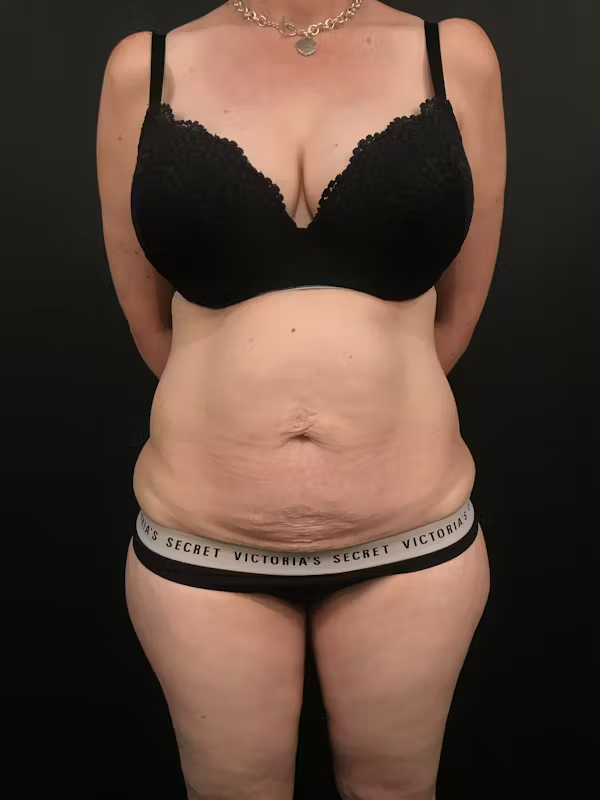 Before Image: Tummy Tuck - front