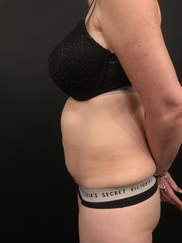 Before Image: Tummy Tuck - left-side