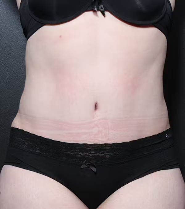 Tummy Tuck