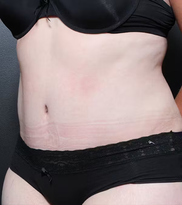 Tummy Tuck