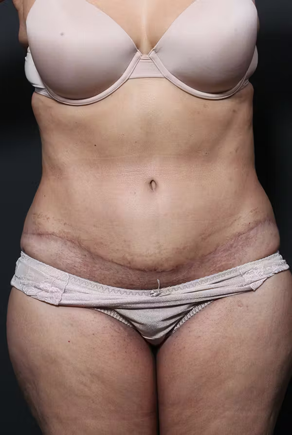 After Image: Tummy Tuck - front