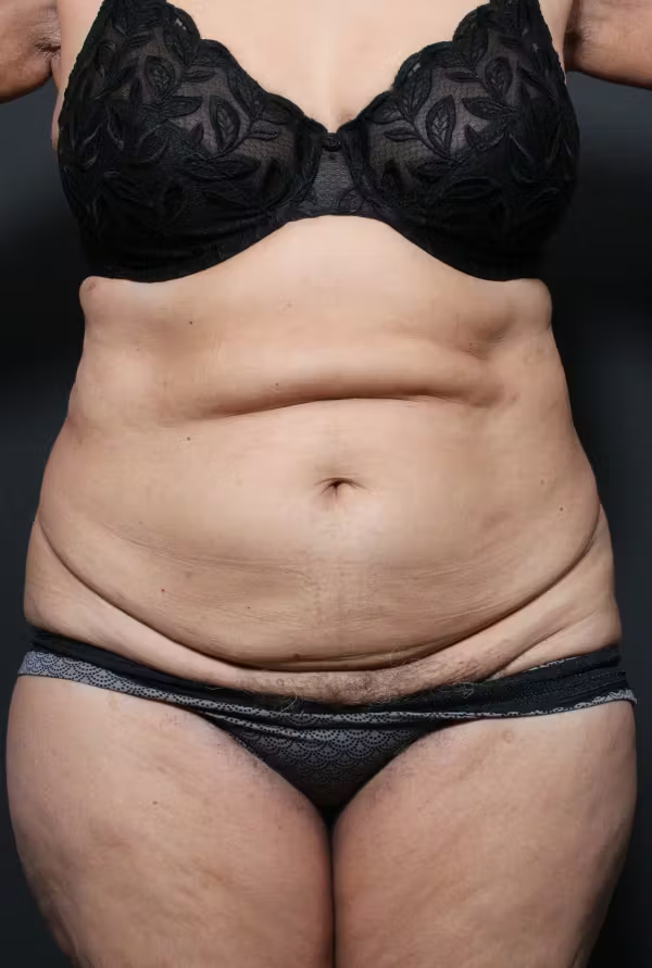 Before Image: Tummy Tuck - front