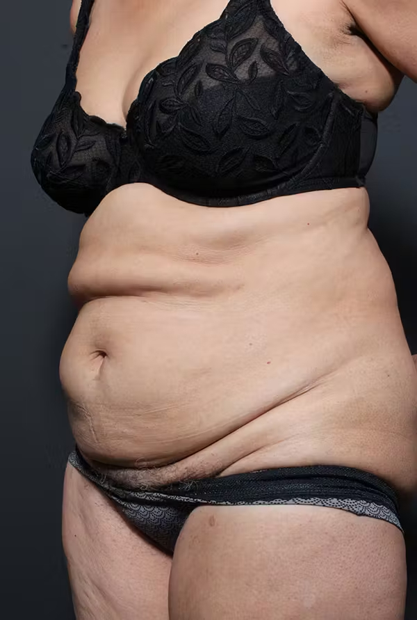 Before Image: Tummy Tuck - left-front-oblique