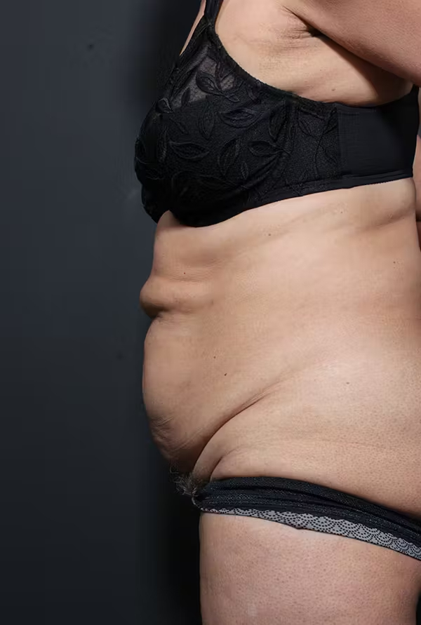 Before Image: Tummy Tuck - left-side