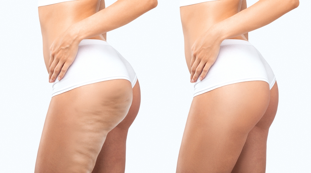 Before and after of a woman's things and legs after getting liposuction to treat lipedema.