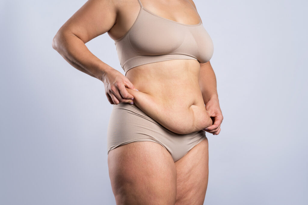 Close up of a young woman's torso with loose skin after weight loss, in need of skin removal surgery. Close up of a young woman's torso with loose skin after weight loss, in need of skin removal surgery.