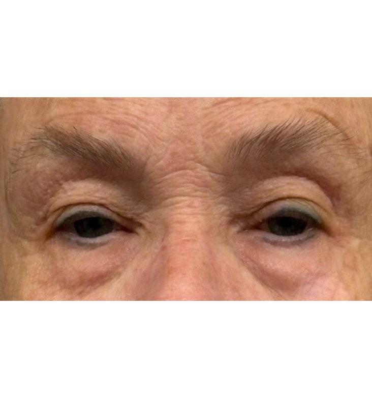 Upper and Lower Blepharoplasty