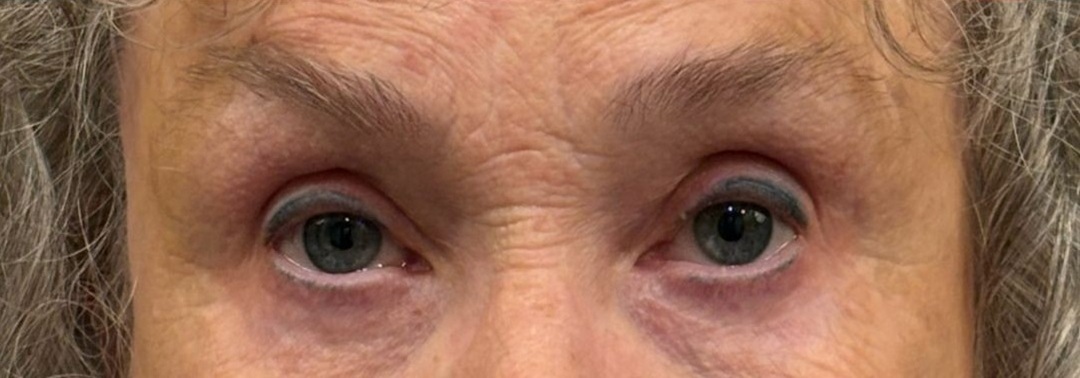 Upper and Lower Blepharoplasty