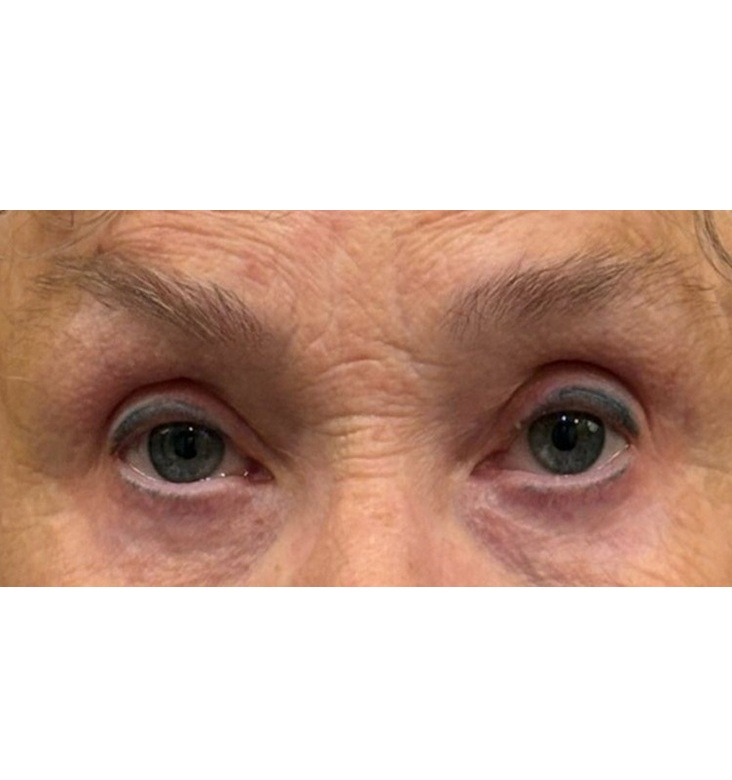 Upper and Lower Blepharoplasty