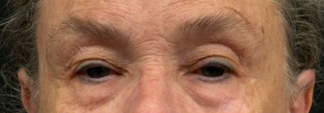 Upper and Lower Blepharoplasty
