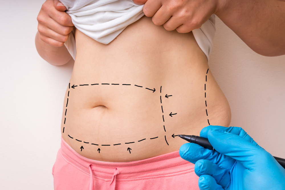 Doctor drawing on woman’s abdomen to prepare for tummy tuck surgery Doctor drawing on woman’s abdomen to prepare for tummy tuck surgery