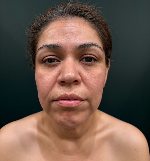 Facelift