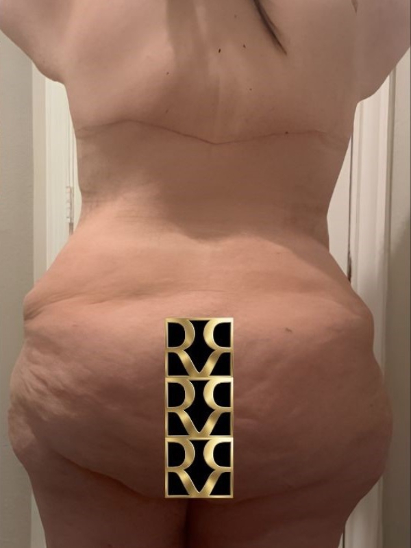 Bra Line Back Lift