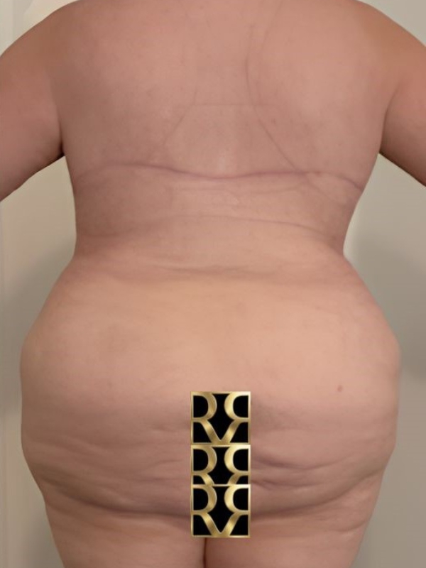 After Image: Bra Line Back Lift - back