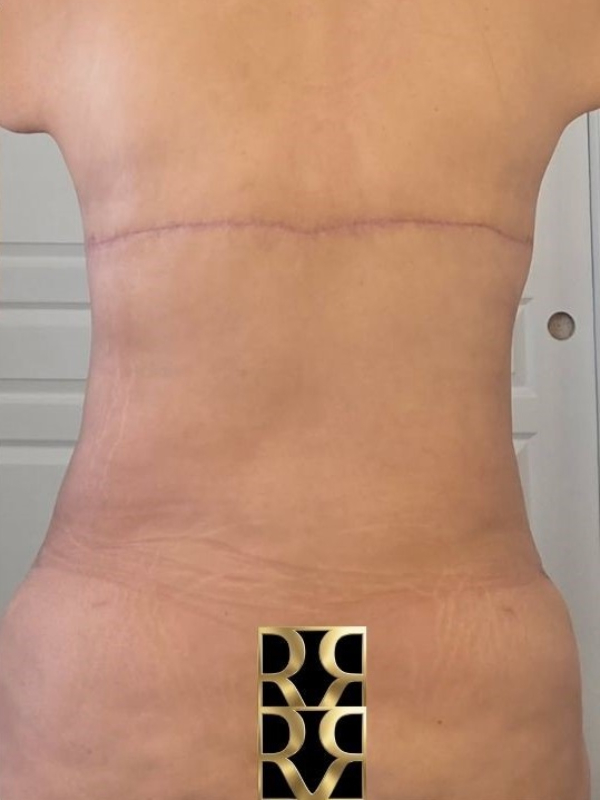 Bra Line Back Lift